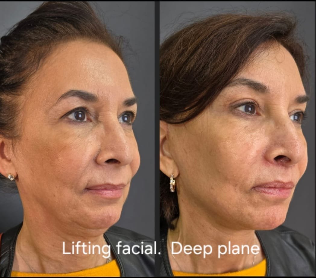 Lifting facial deep plane, foto 2 — antes y después