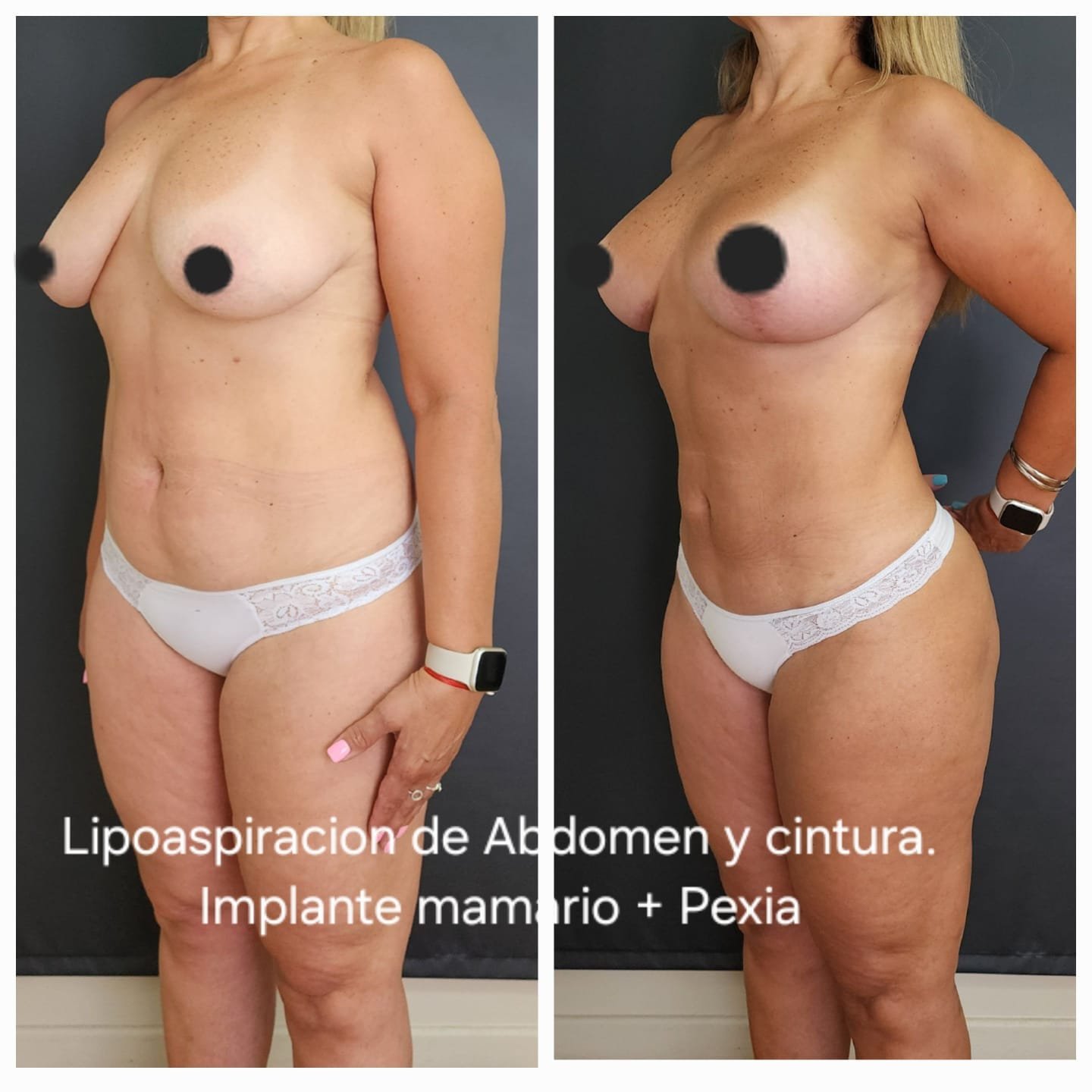 Lipoaspiración de abdomen y cintura, implante mamario y pexia — antes y después