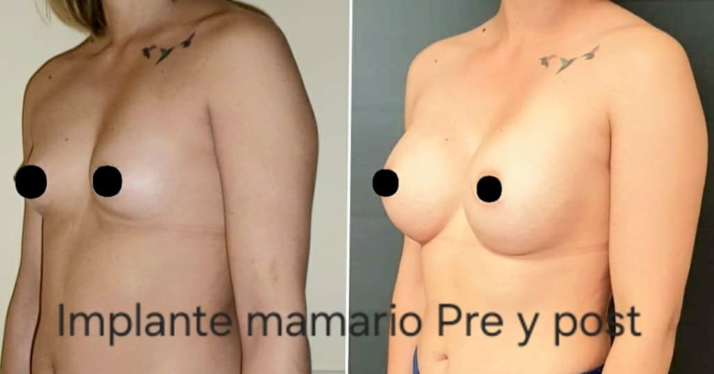 Implante mamario, foto 2 — antes y después